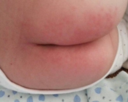 宝宝纸尿裤过敏怎么办