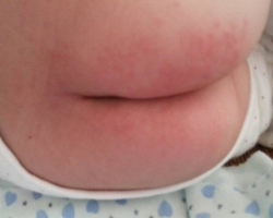 纸尿裤过敏的症状