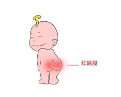 纸尿裤对宝宝皮肤有影响吗？